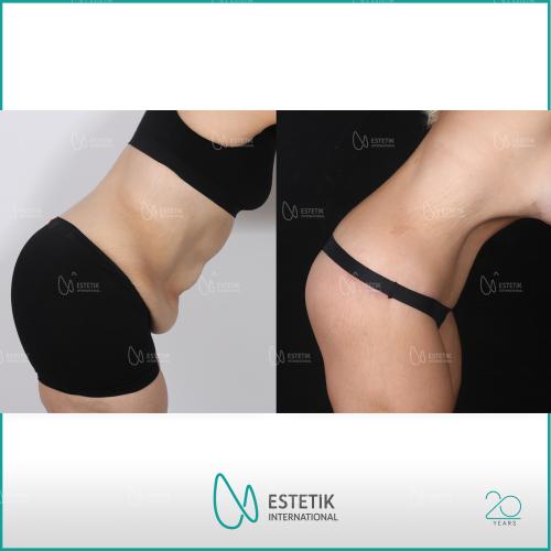 Liposucción Láser Foto antes/después